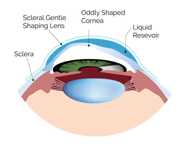 optometrist, Type of Scleral Lenses