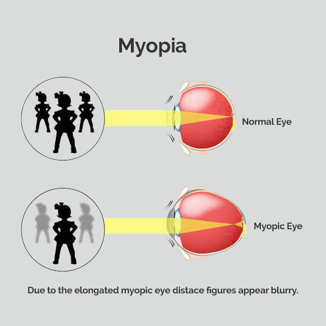 myopia 9 aki helyreállította a látást)