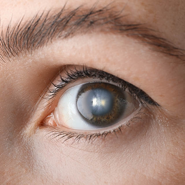 Close-Up-Cataract-Eye-1