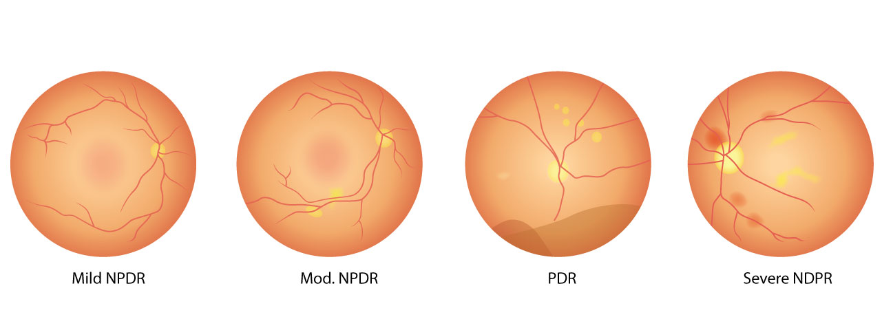 4 stages diabetic retinopathy
