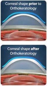 CRT image of cornea shaping