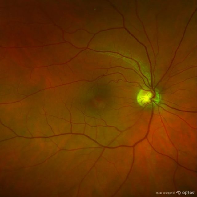 optos retina image