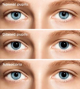 dilated pupils 330×366@2x