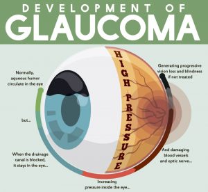 glaucoma explained