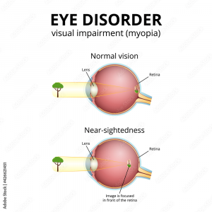Eye Disorder
