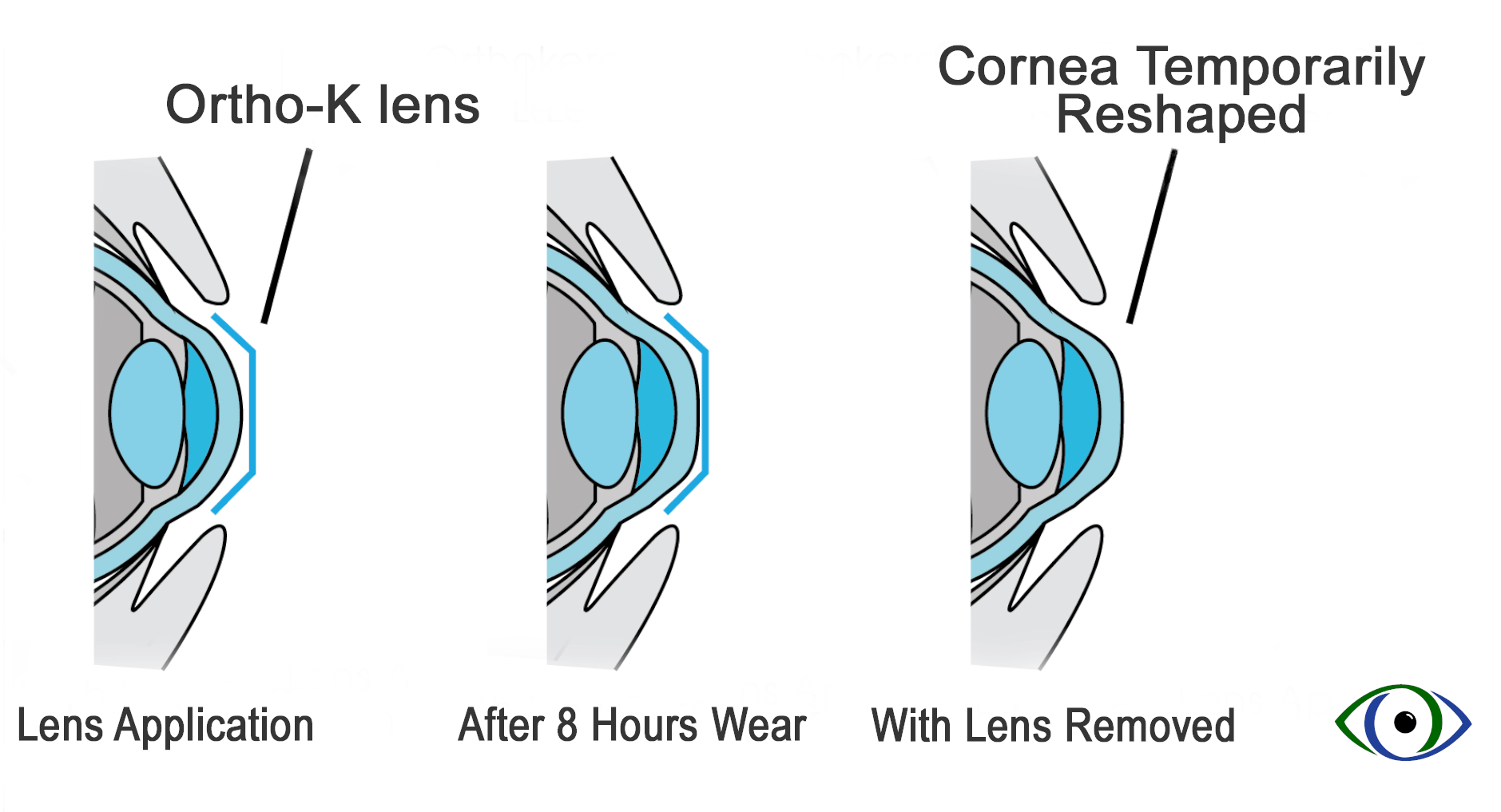 Сколько стоит ночные линзы для восстановления зрения. Ночные линзы для восстановления зрения принцип действия. Принцип работы ночных линз. Как работают ортокератологические линзы. Ночные жесткие линзы для восстановления зрения.