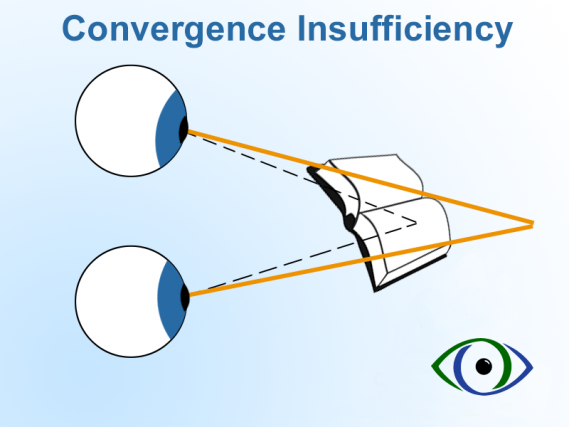 Convergence Insufficiency