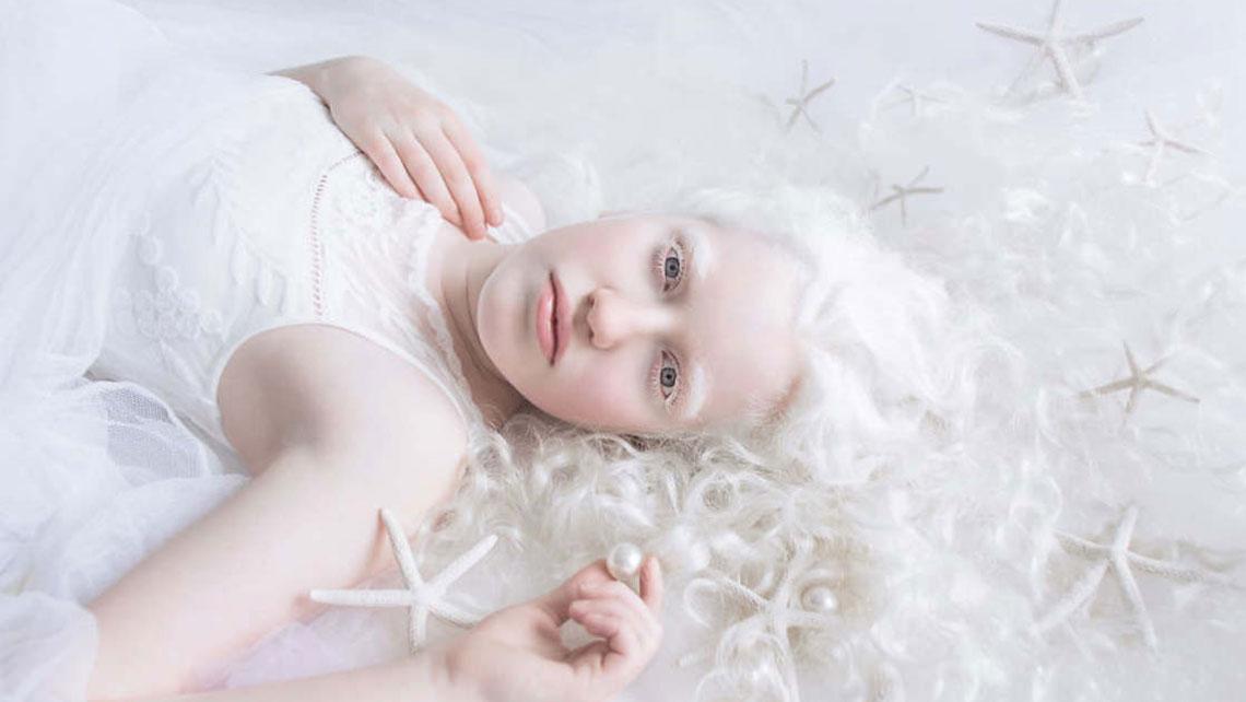 young lady with Low Vision Care For Albinism