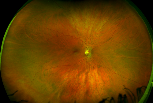color healthy retina california