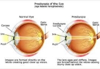 Presbyopia.jpeg