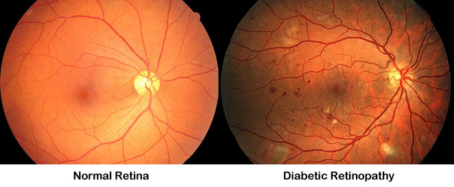 retina images
