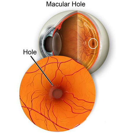 macular hole