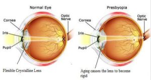 presbyopia test1