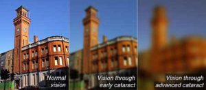 vision through cataract