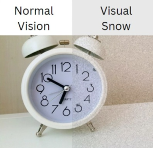 visual snow