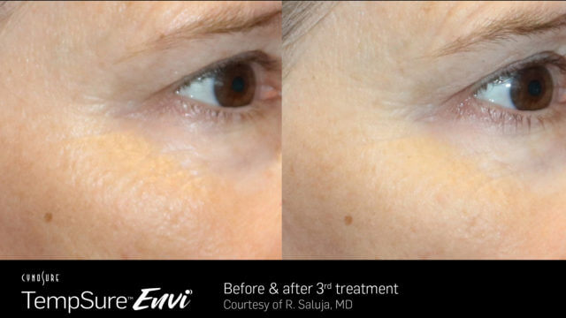 TempSure Envi Before and After Image 12