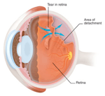 Retinal detachments