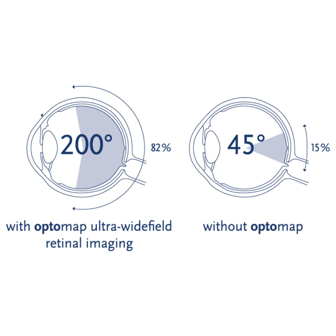 Optomap Widefield Retinal Imaging