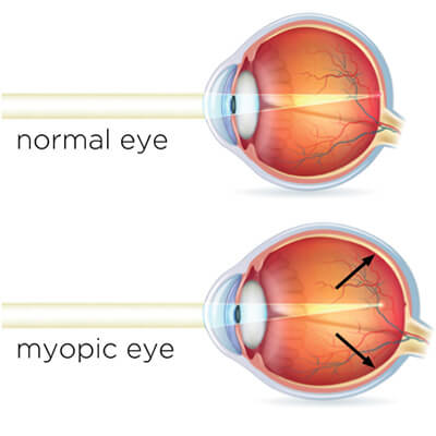 normal vs myopia diagram 1