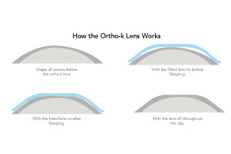 orthok lens thumbnail.jpg