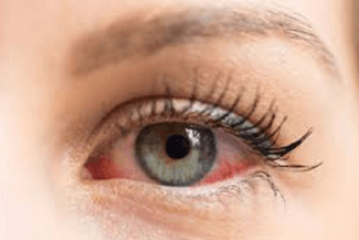 Red Eye and Dry Eye Syndrome (2)