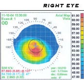 corneal_topography_right_ax