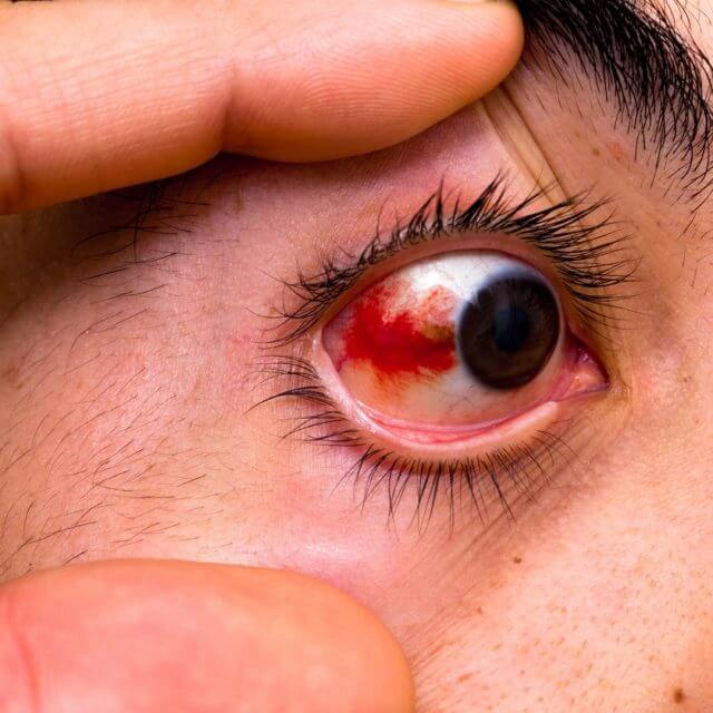 Artisan Optics Common Eye Injury