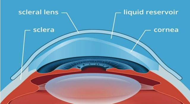 What Are Scleral Lenses