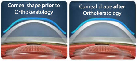 orthokeratology pre post
