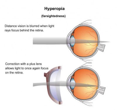 Hyperopia Long Sightedness 400×376