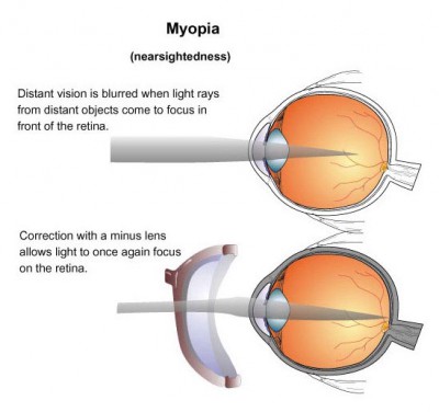 Myopia Short Sightedness 400×376