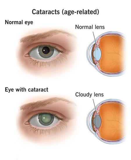 Cataracts (Age Related)