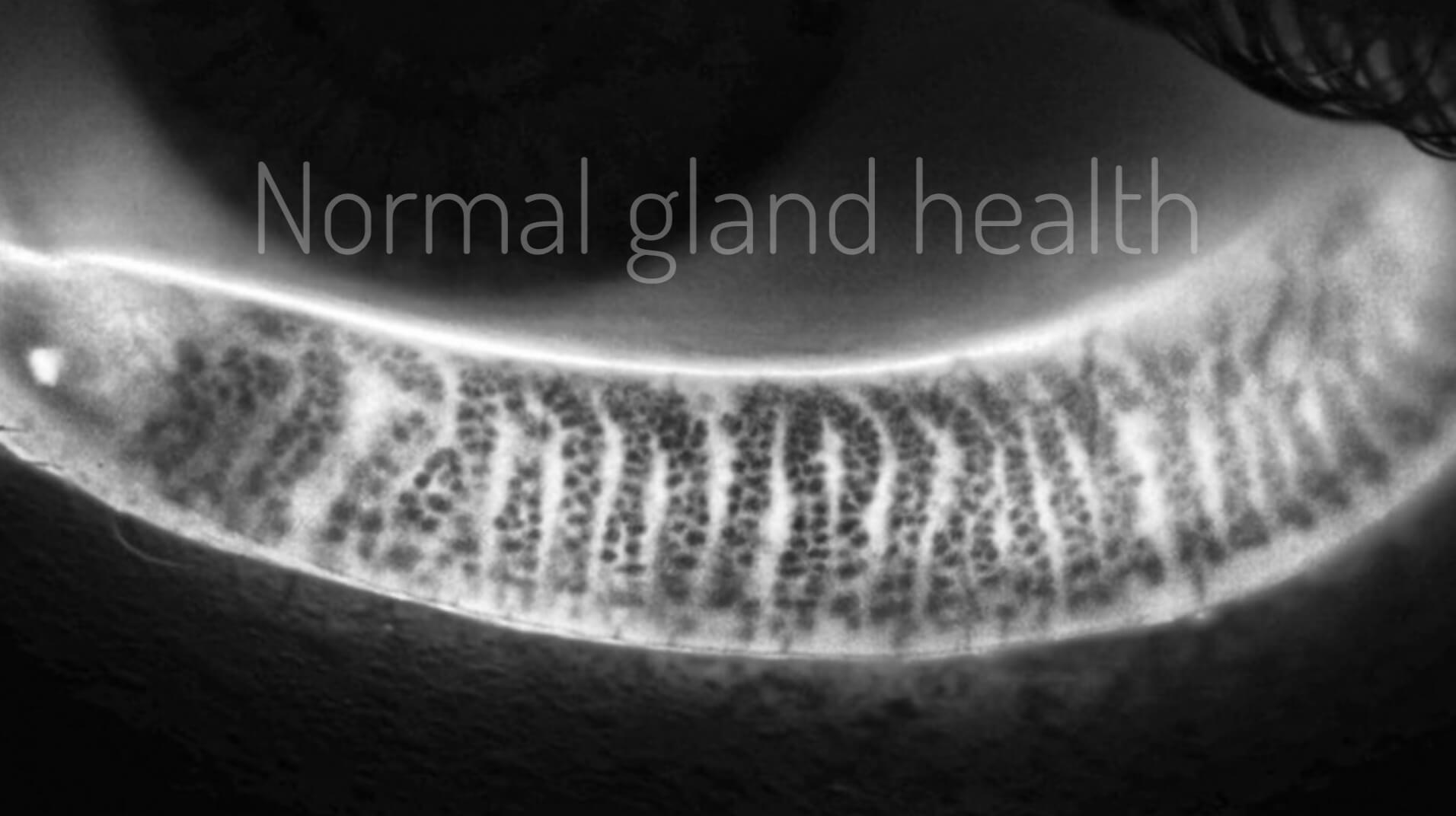 normal gland
