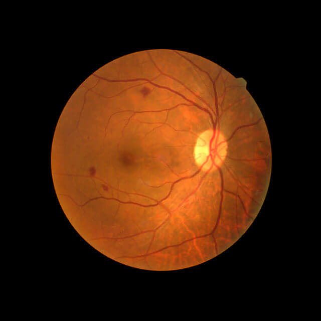 Retinal photograph revealing diabetic eye disease