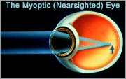 myopia 1