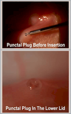Punctual Occlusion for Dry Eye1