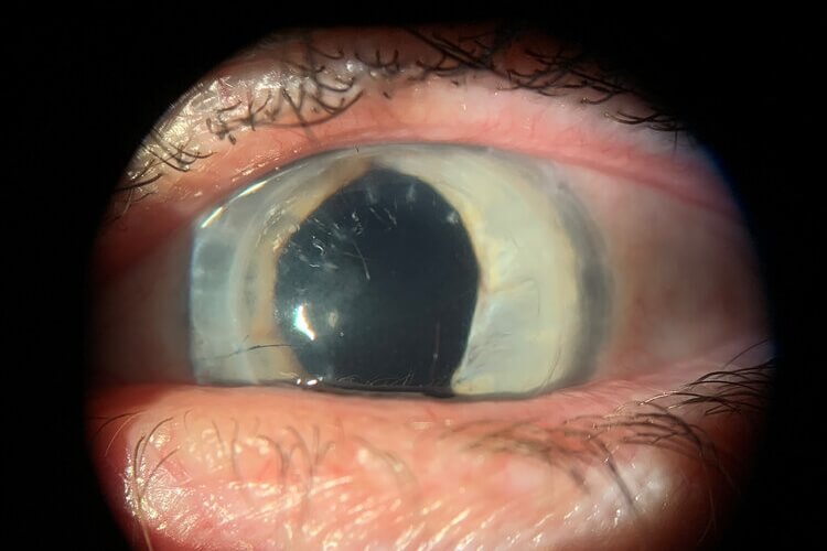 aniridia+and+corneal+transplant