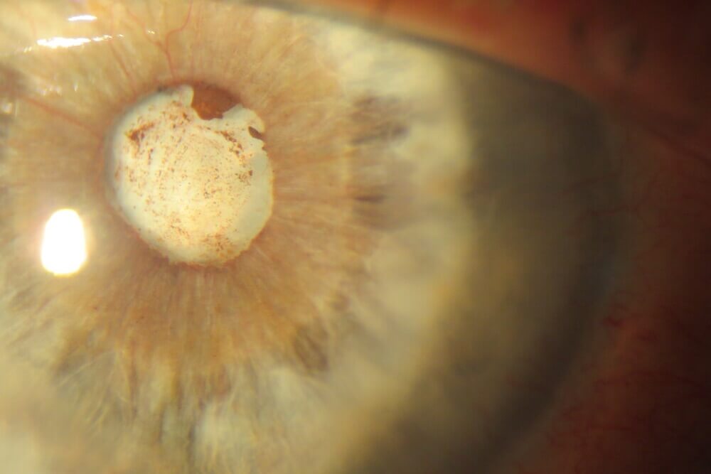 Dense+cataract+with+angle+closure+and+neovascularization+(2)