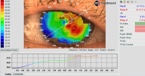Scleral lenses and eye cancer topography