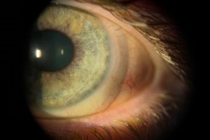 scleral lens ring on eye