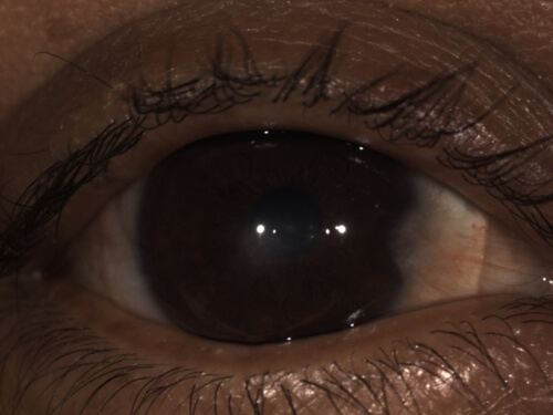 scleral lens eye upclose