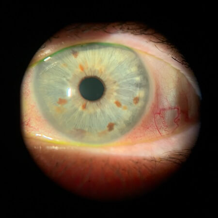 OS cornea and temporal conj irregularity