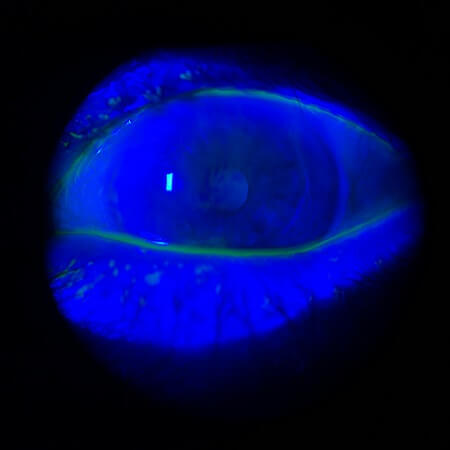 OS cornea with NaFl 3