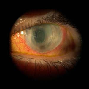 AR left eye cornea