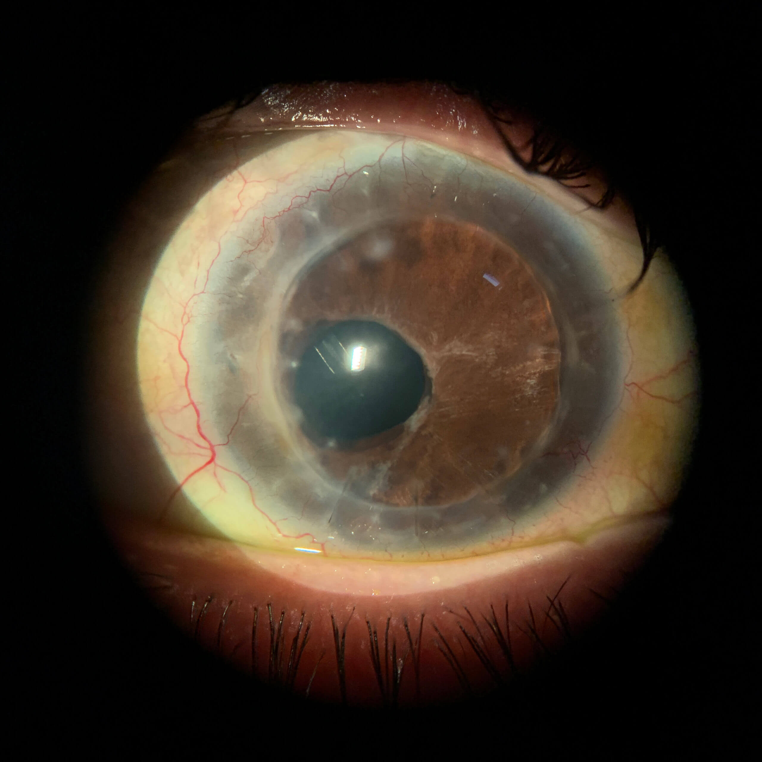 OD corneal transplant with decentered pupil and tube