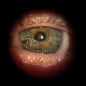 OS PKP with sutures and irregular pupil 1