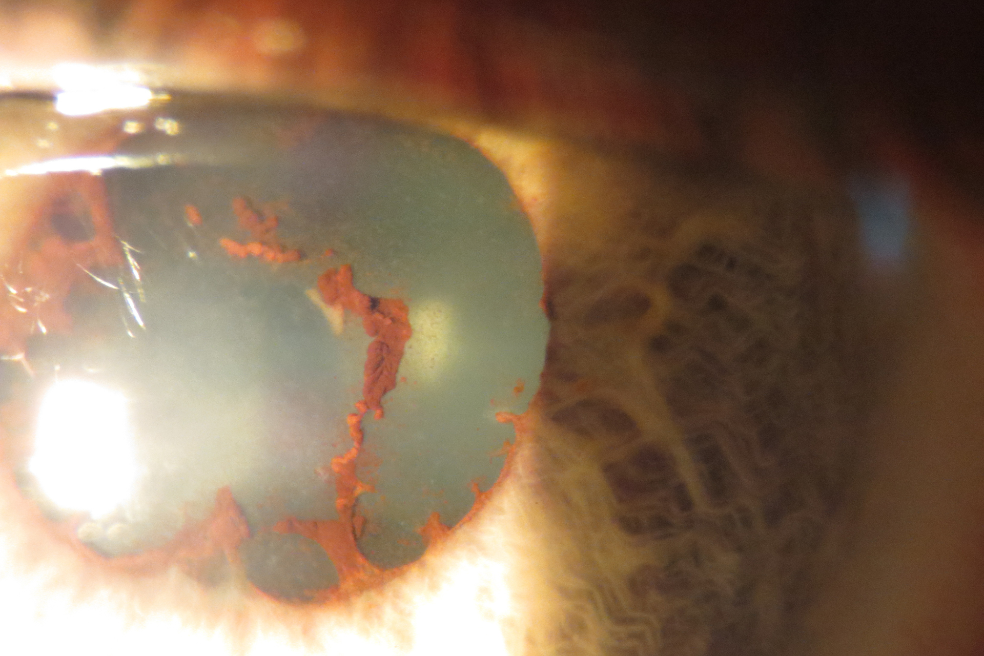 posterior synechiae eye damage anterior uveitis