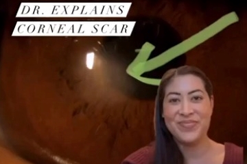 Dr Explains Corneal Scar thumbnail