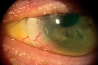 Corneal Transplant Patient Goes from Count Fingers to 20 60 Vision