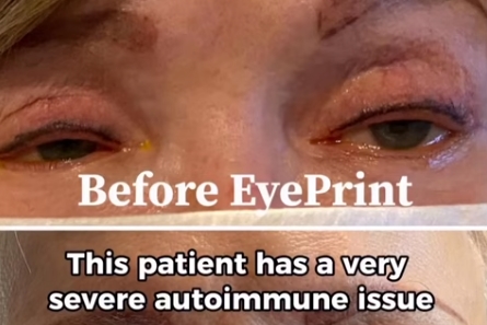 EyePrint PRO helps patients with Autoimmune Disease thumbnail
